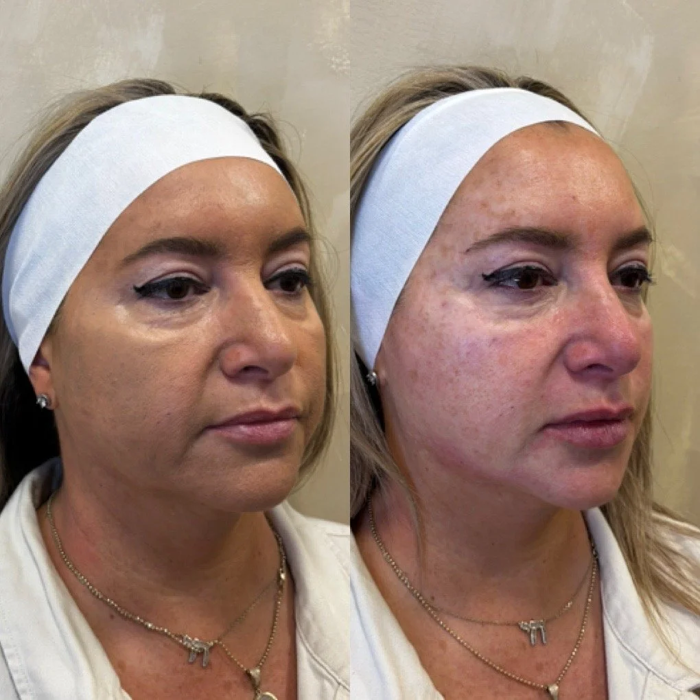 Full Face Filler before and after result