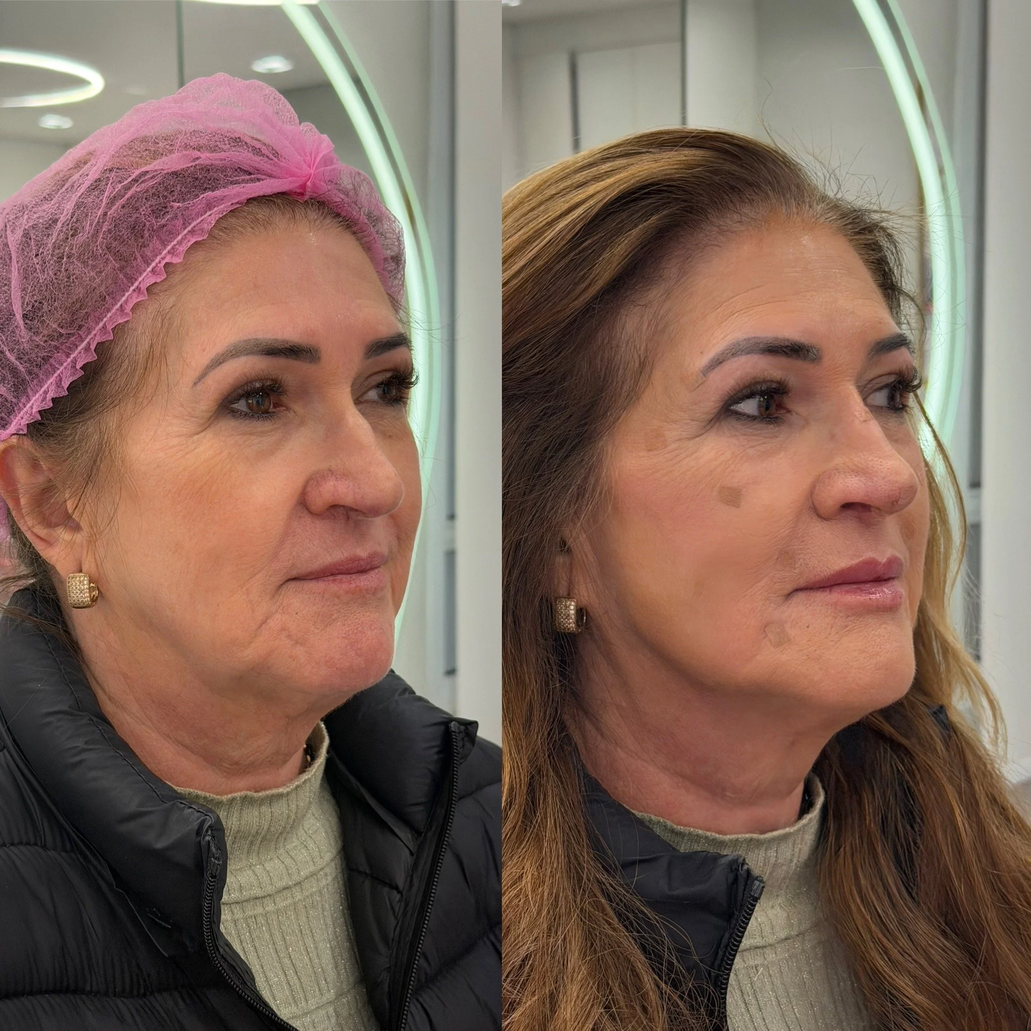 Full Face Filler before and after result