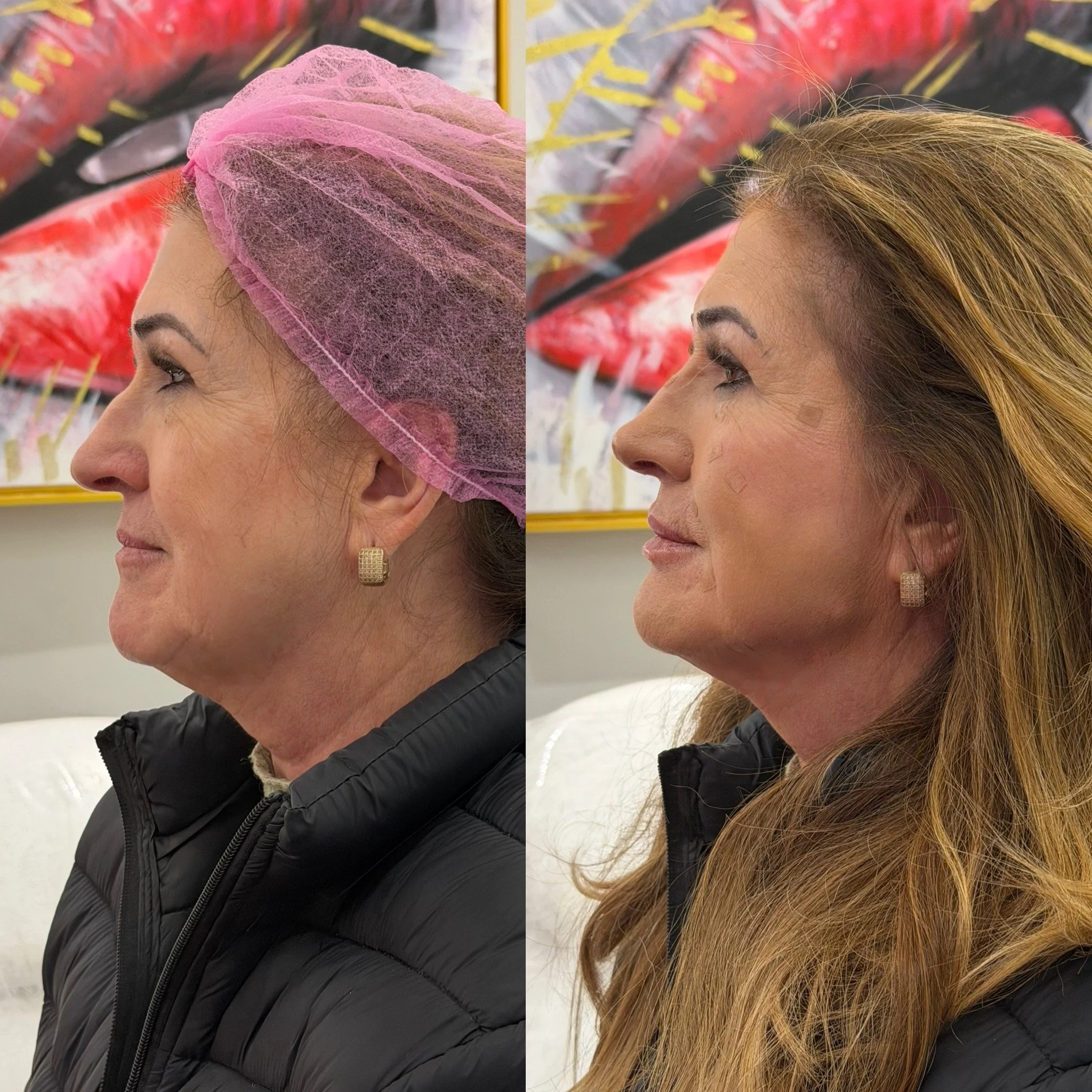 Full Face Filler before and after result