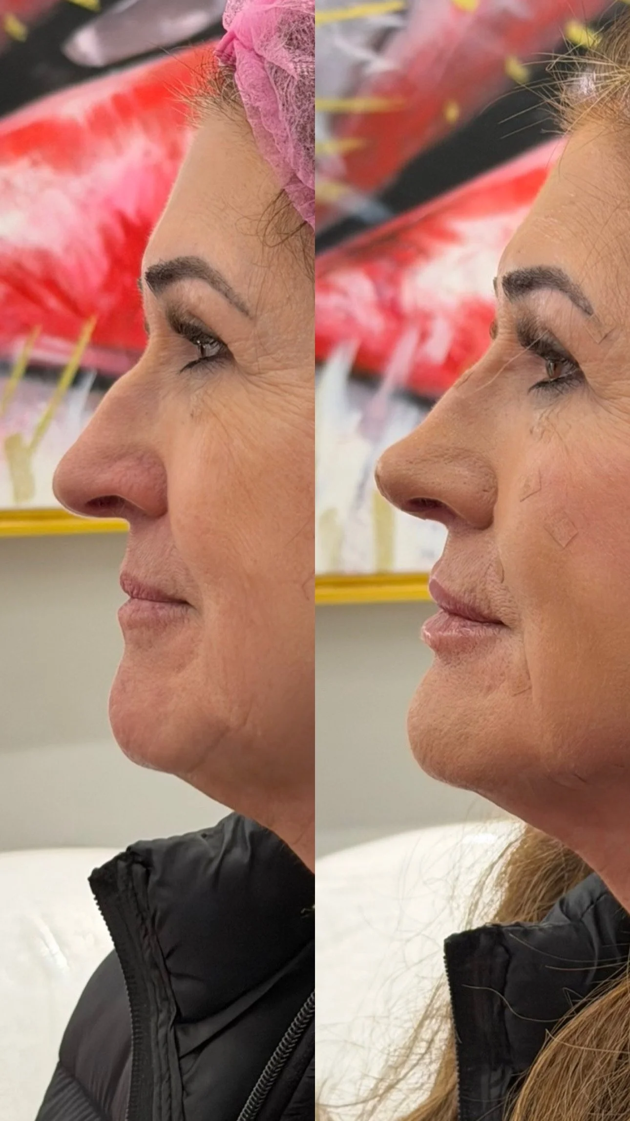 Nose Filler before and after result