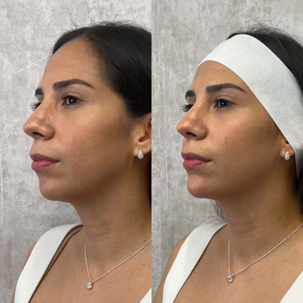 Chin Filler before and after result