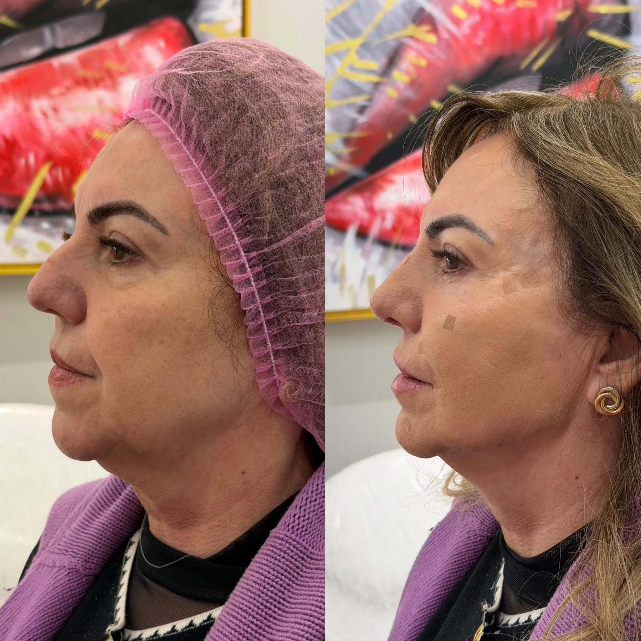 Full Face Filler before and after result