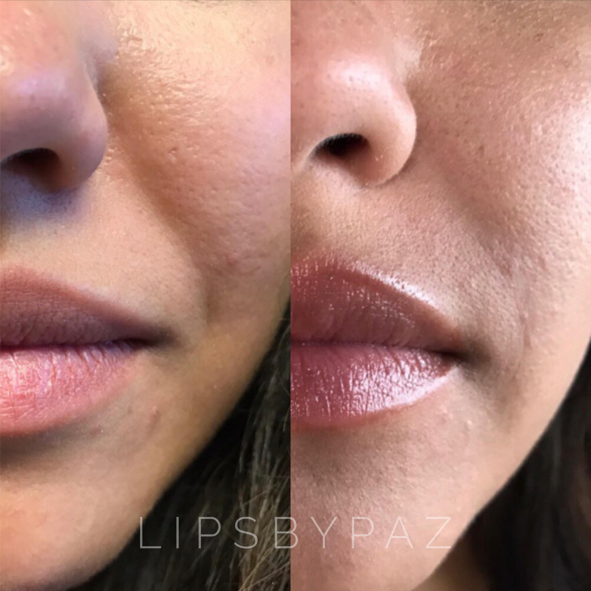 PRF / EZ Gel before and after result