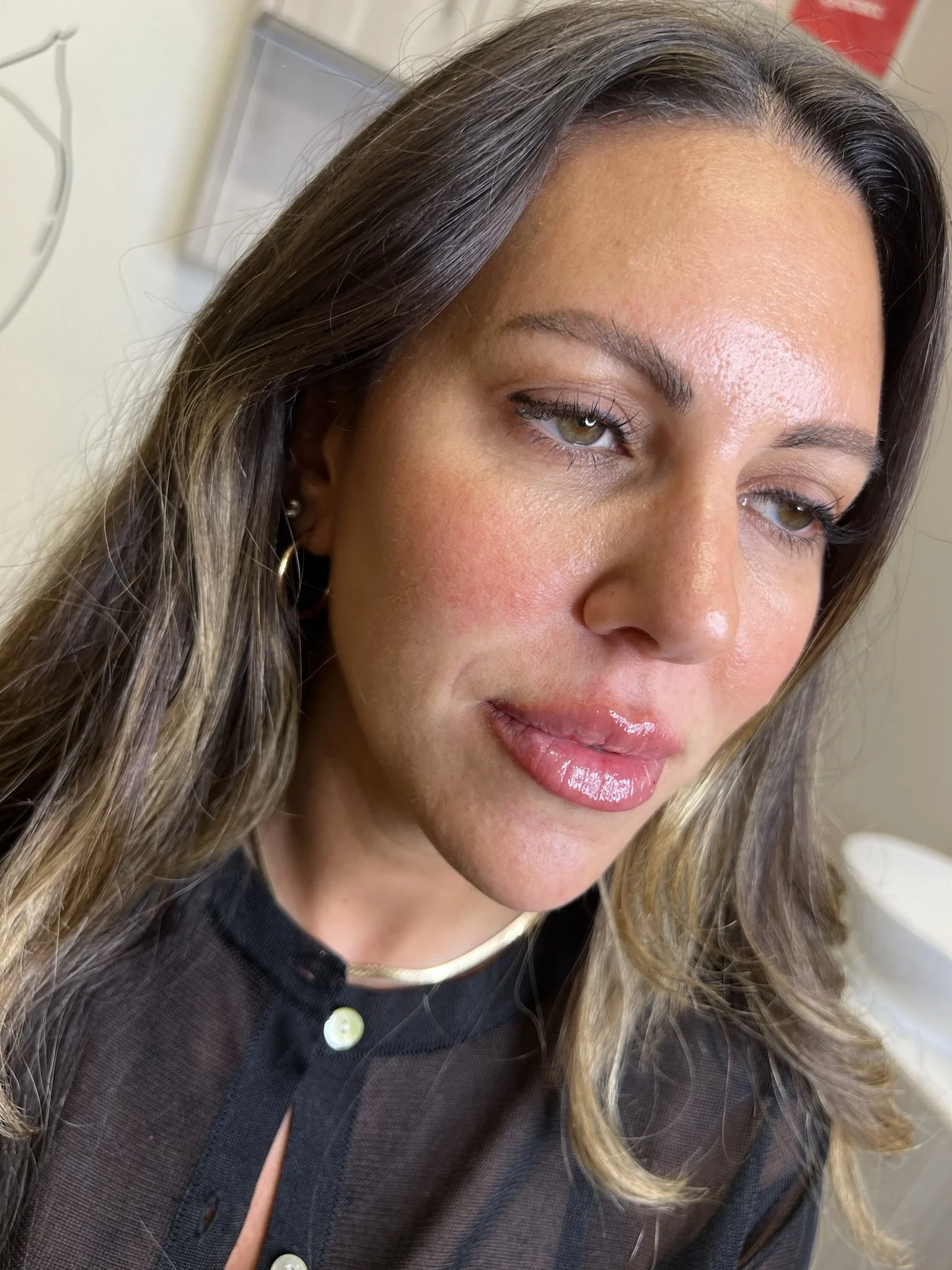 Lip Filler before and after result
