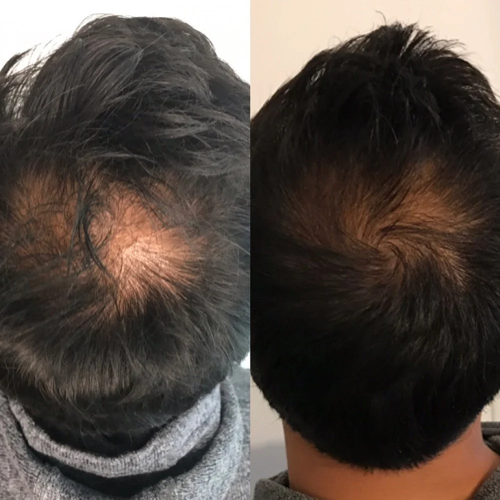 Hair Growth PRF before and after result