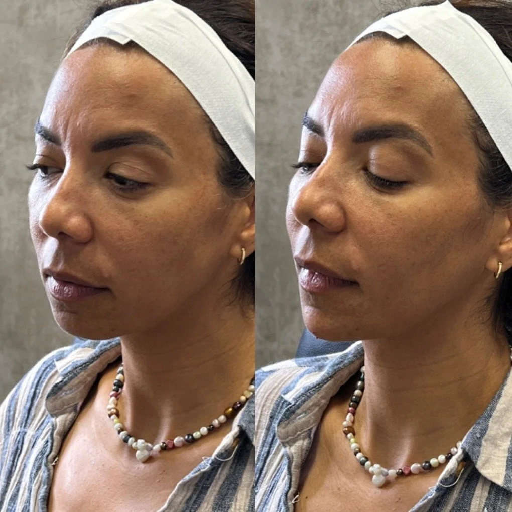 Chin Filler before and after result