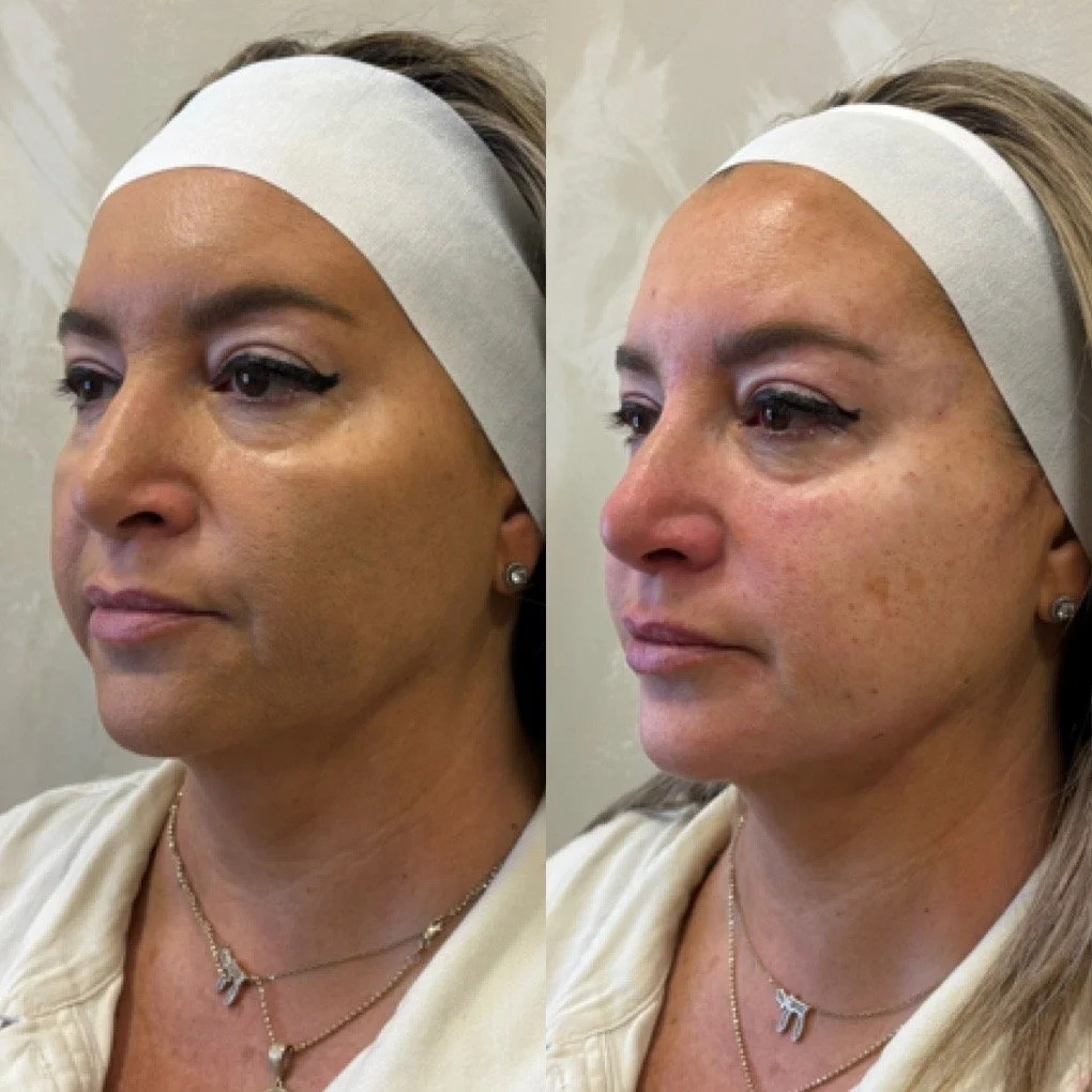 Full Face Filler before and after result