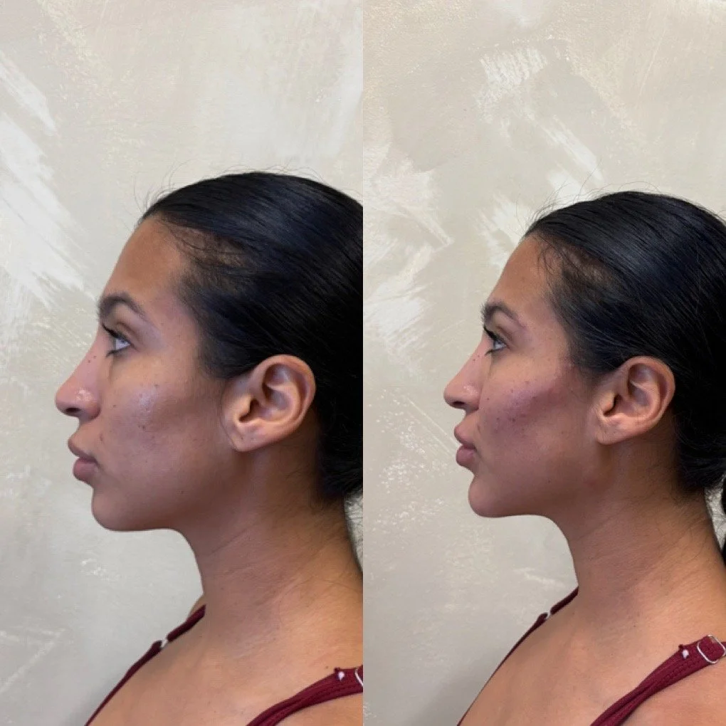 Full Face Filler before and after result