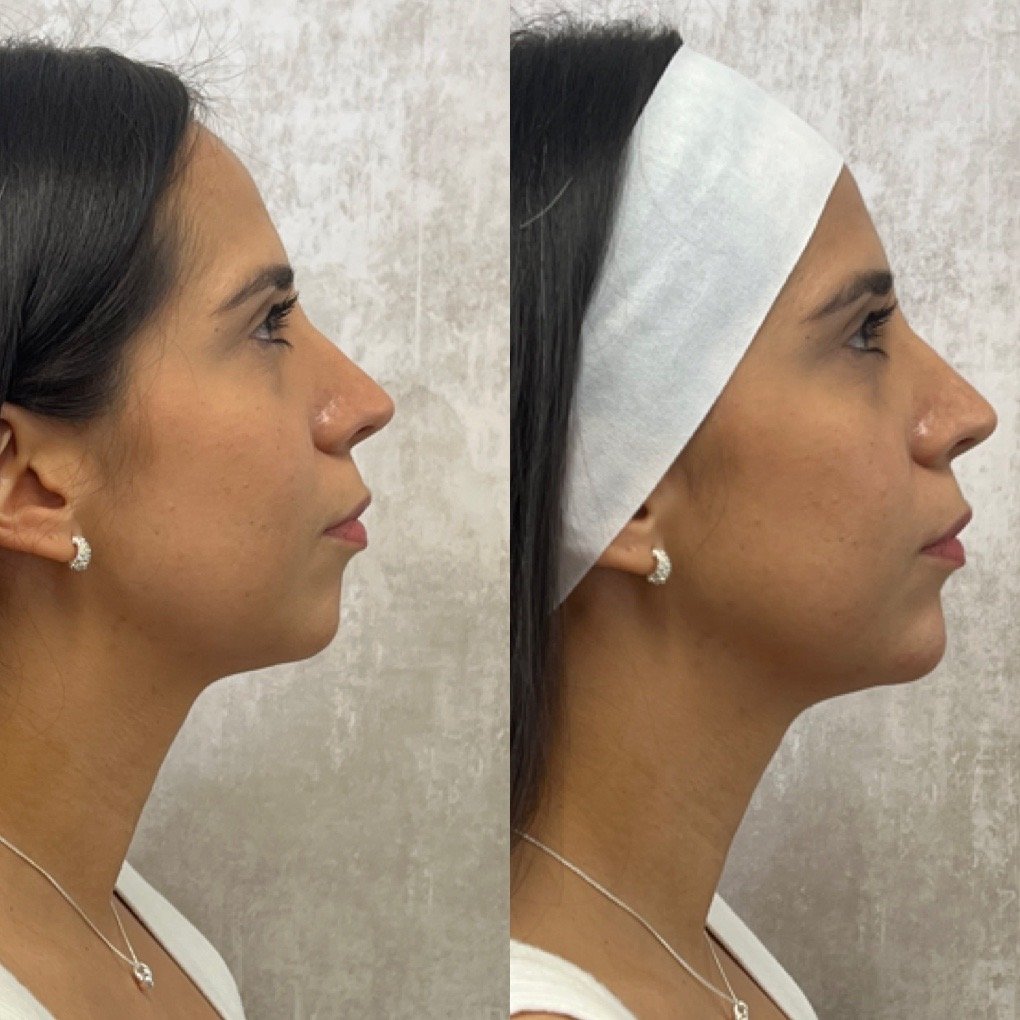 Chin Filler before and after result