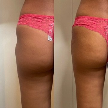 Body Contouring before and after result