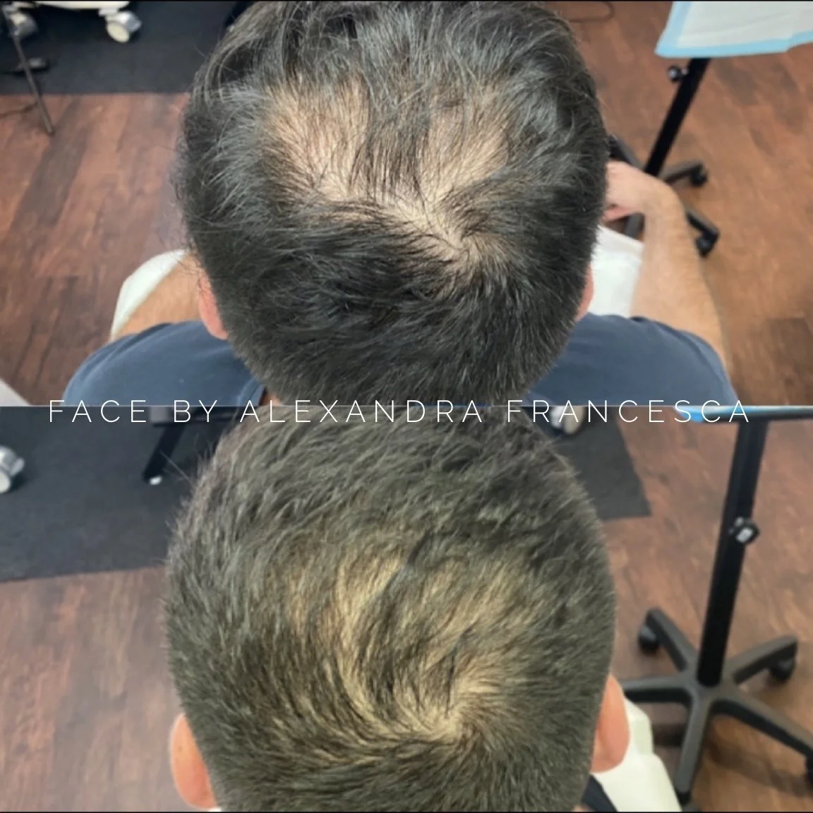 Hair Growth PRF before and after result