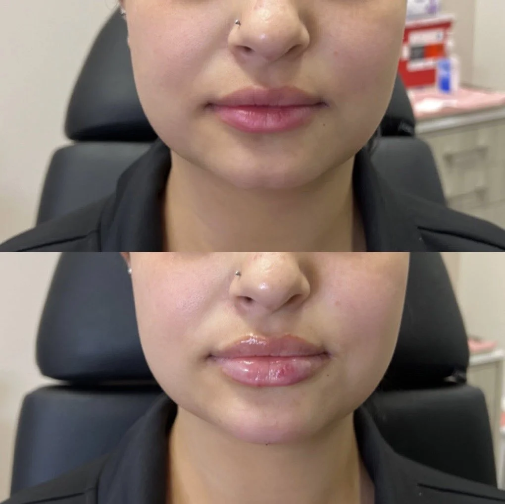 Lip Filler before and after result