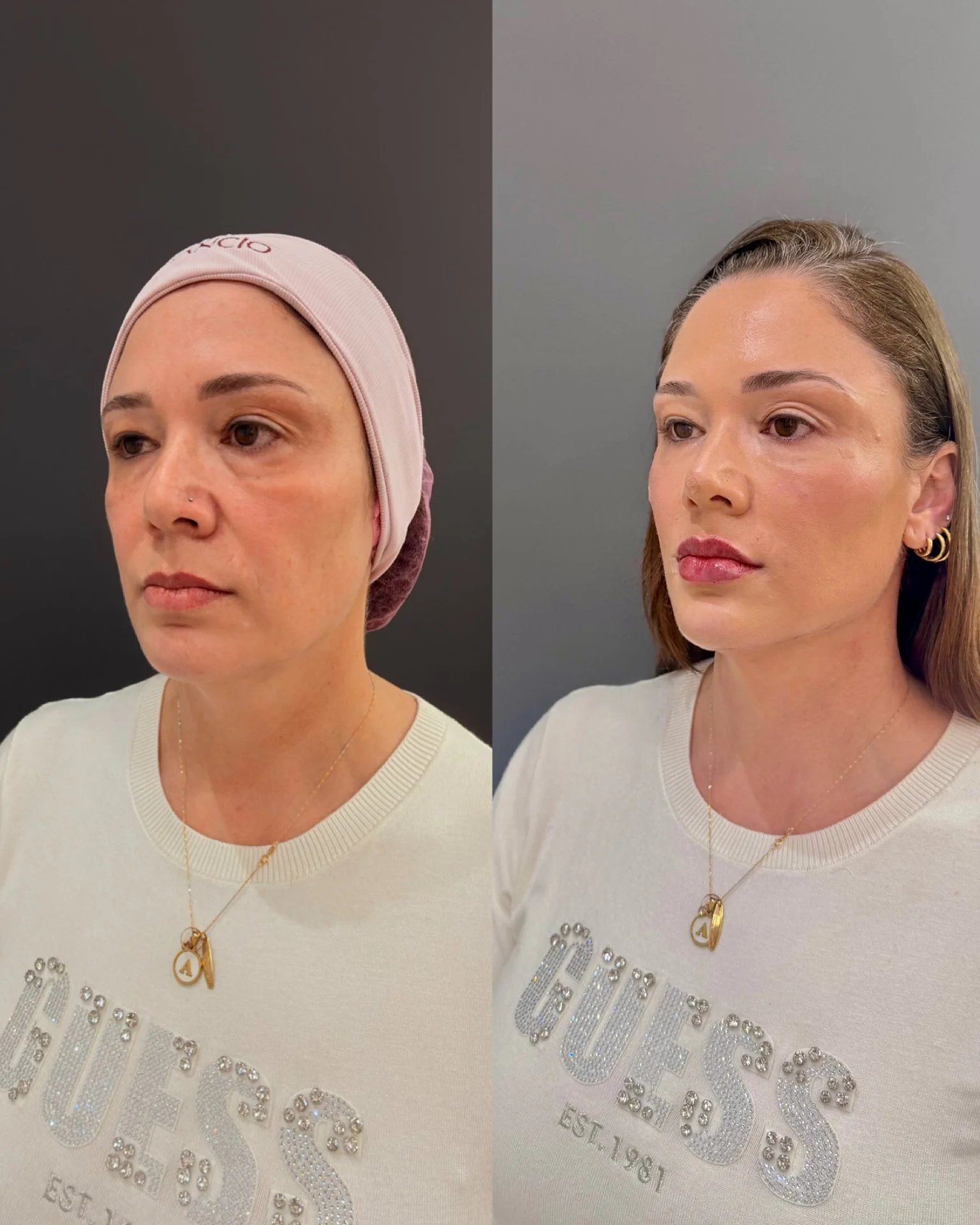 Full Face Filler before and after result