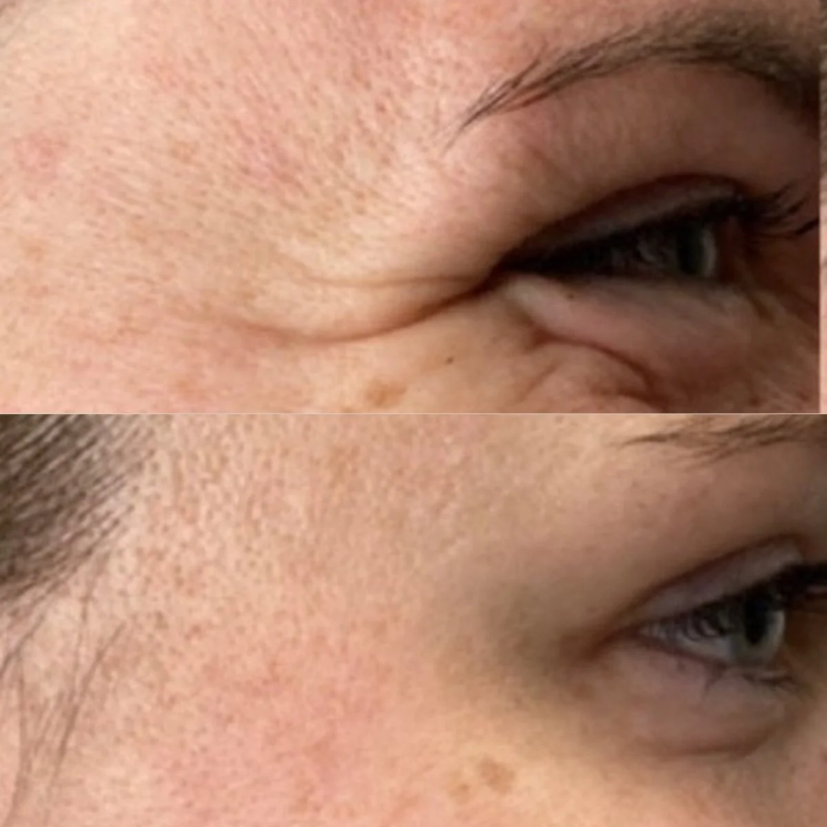 Botox before and after result