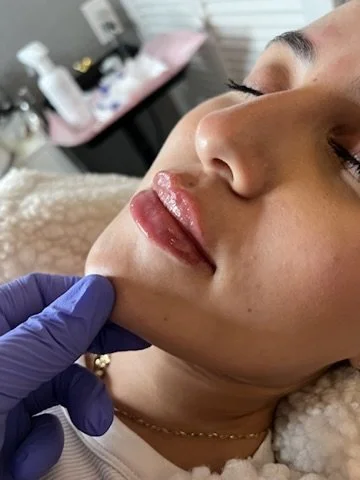 Lip Filler before and after result