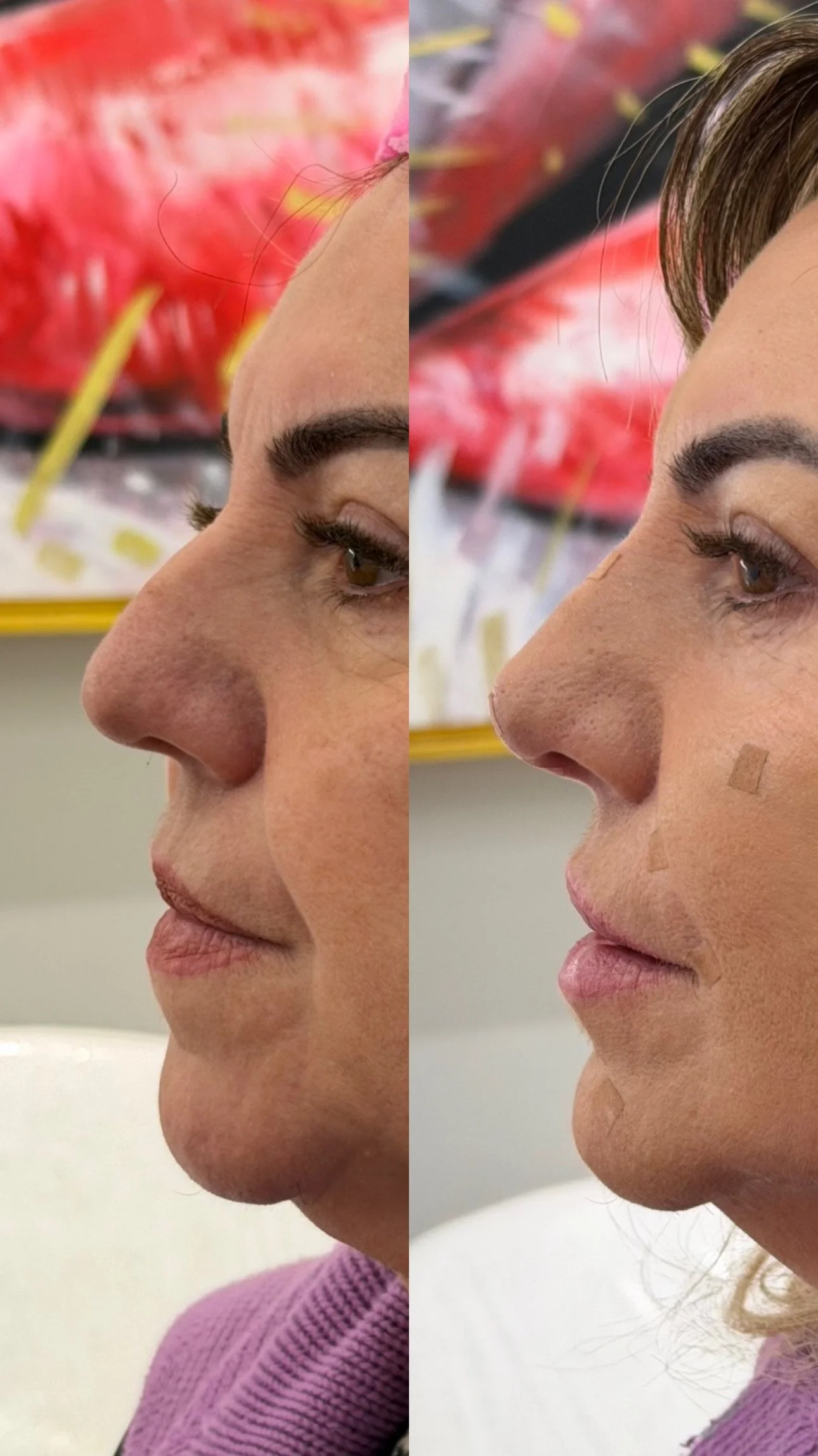 Nose Filler before and after result