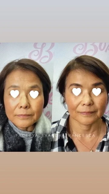 Cheek Filler before and after result