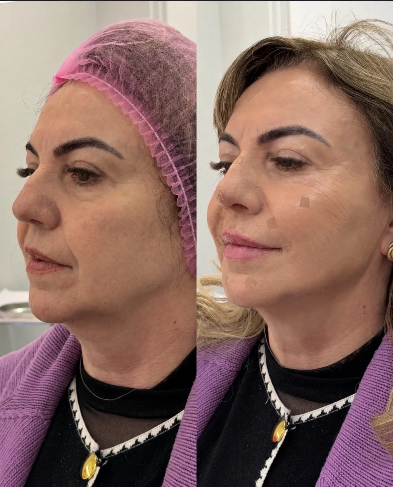 Full Face Filler before and after result
