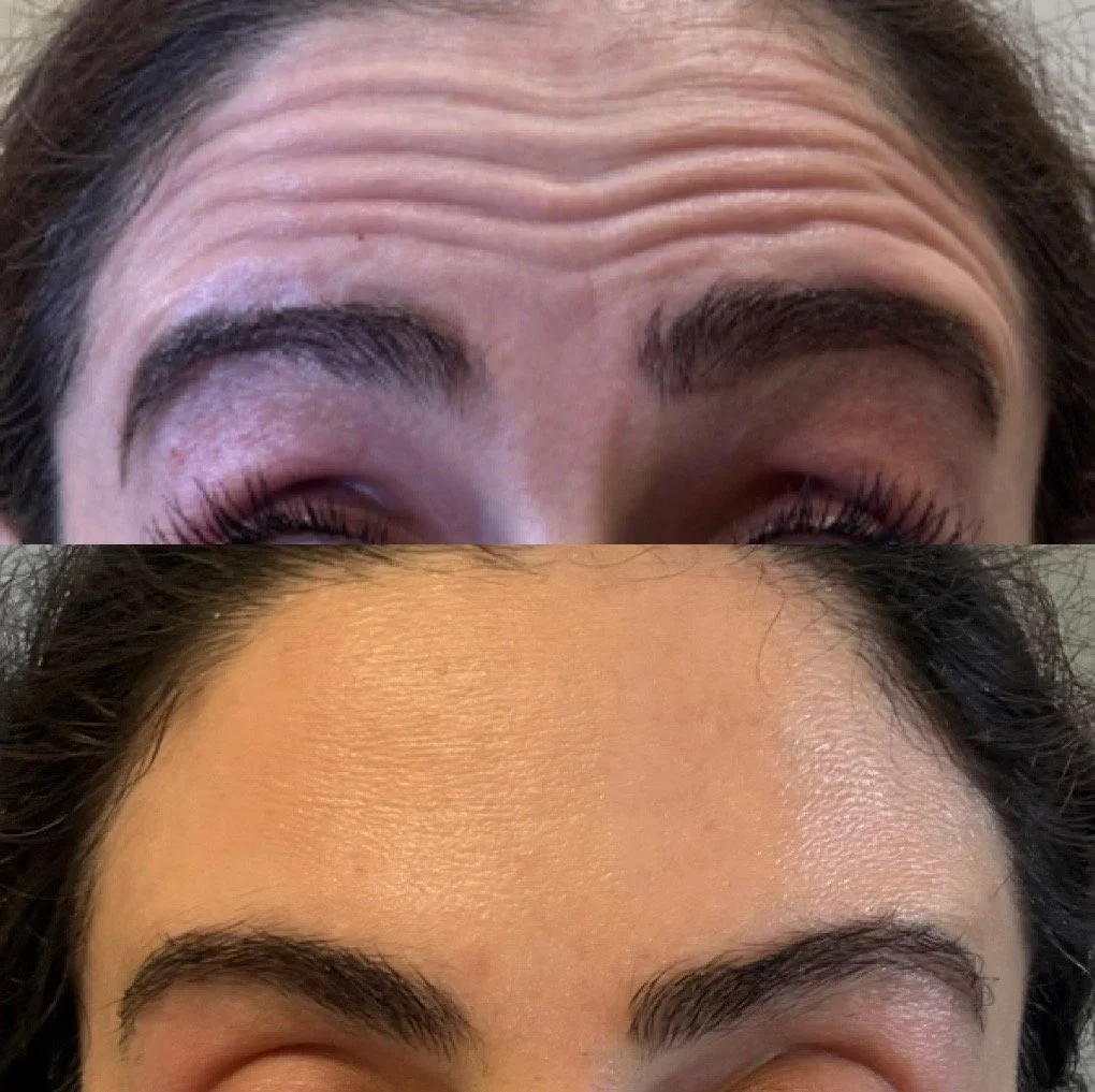 Botox before and after result