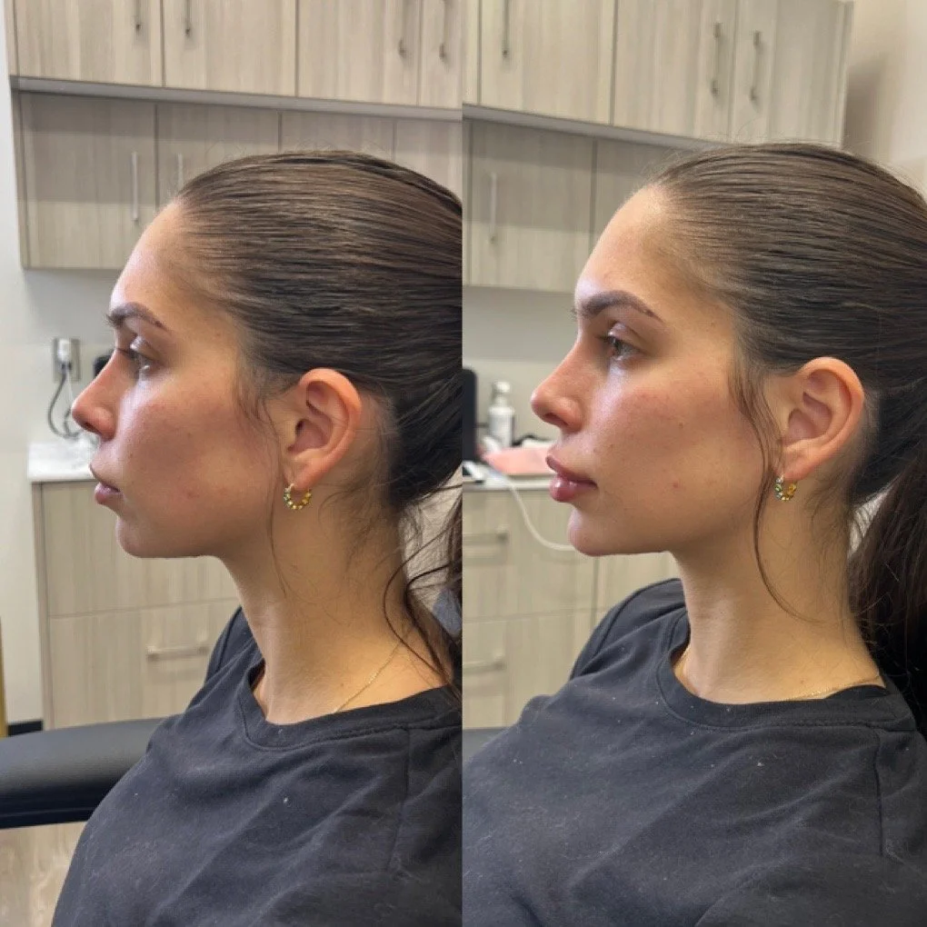 Chin Filler before and after result