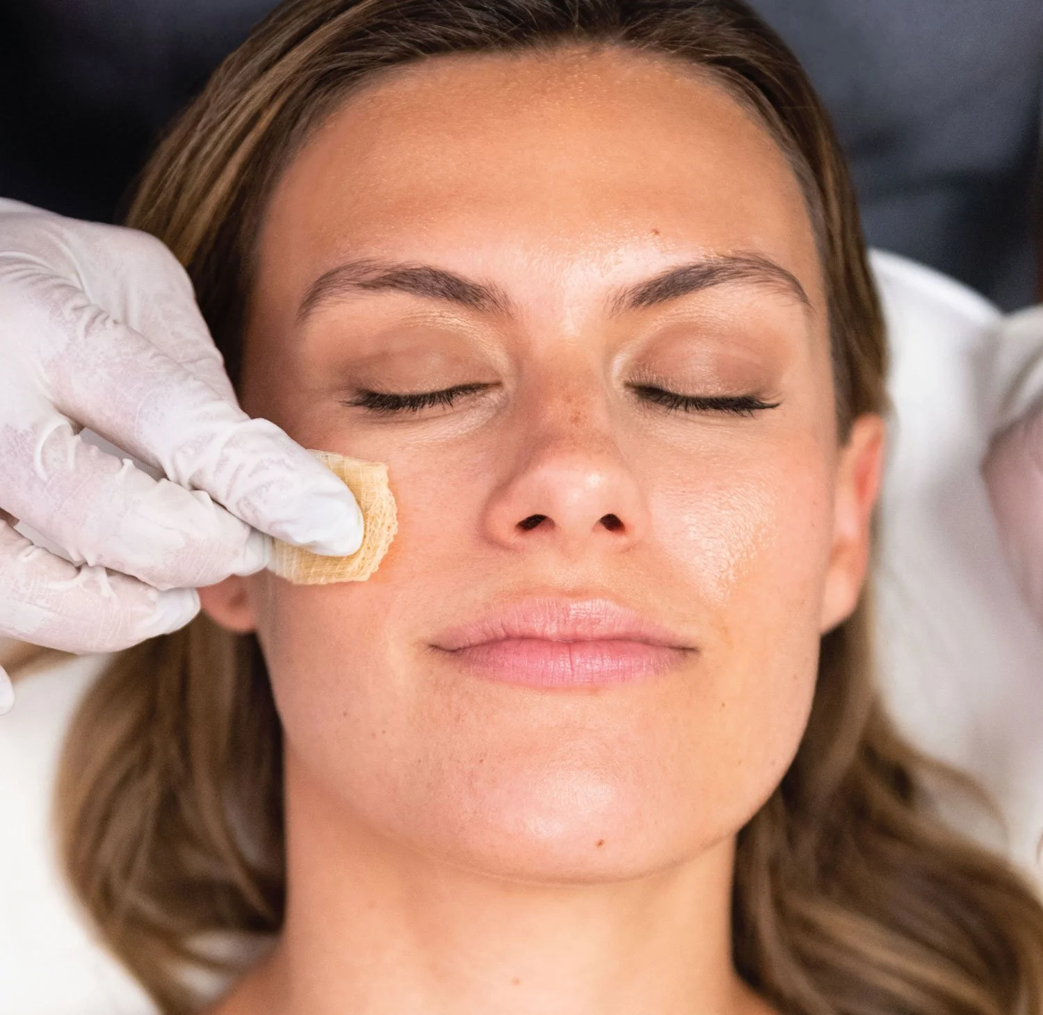VI Peel facial clinical treatment at Evolve Skin Spa