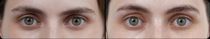 Ultraformer MPT HIFU brow and eye area before and after