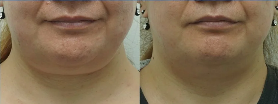 Under-chin fat freezing before and after, front view