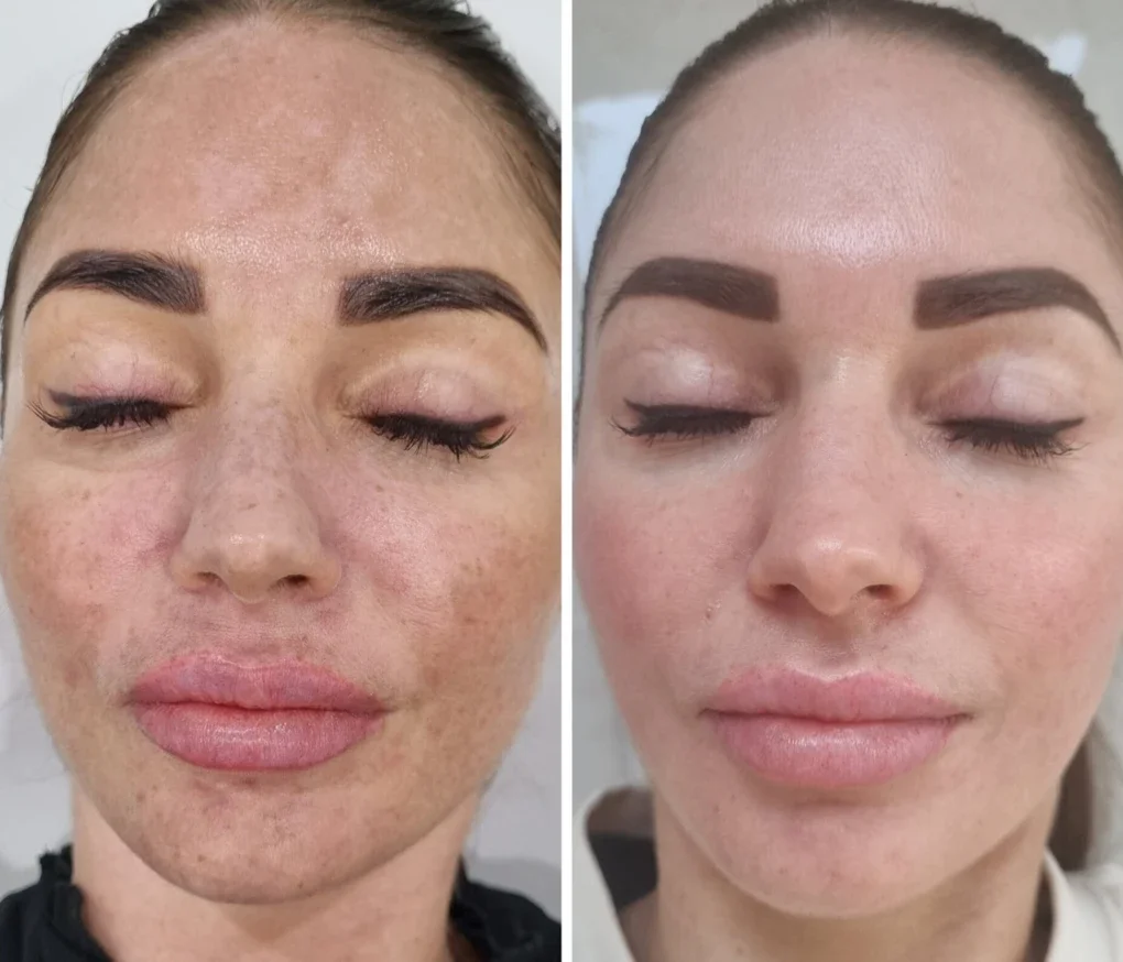 Cosmelan melasma before and after