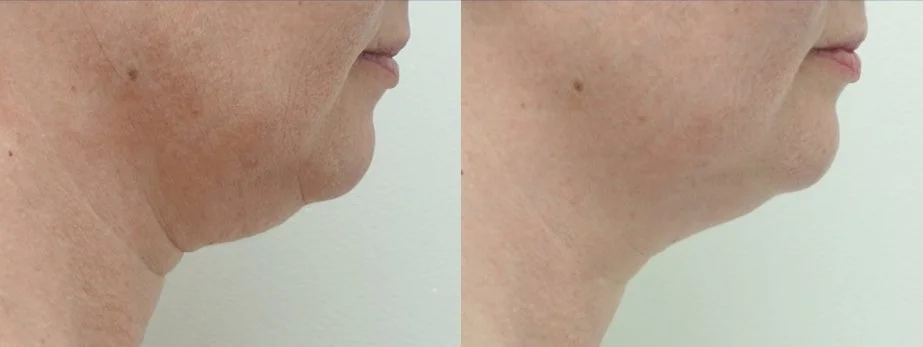 Under-chin and jawline fat freezing before and after, profile view
