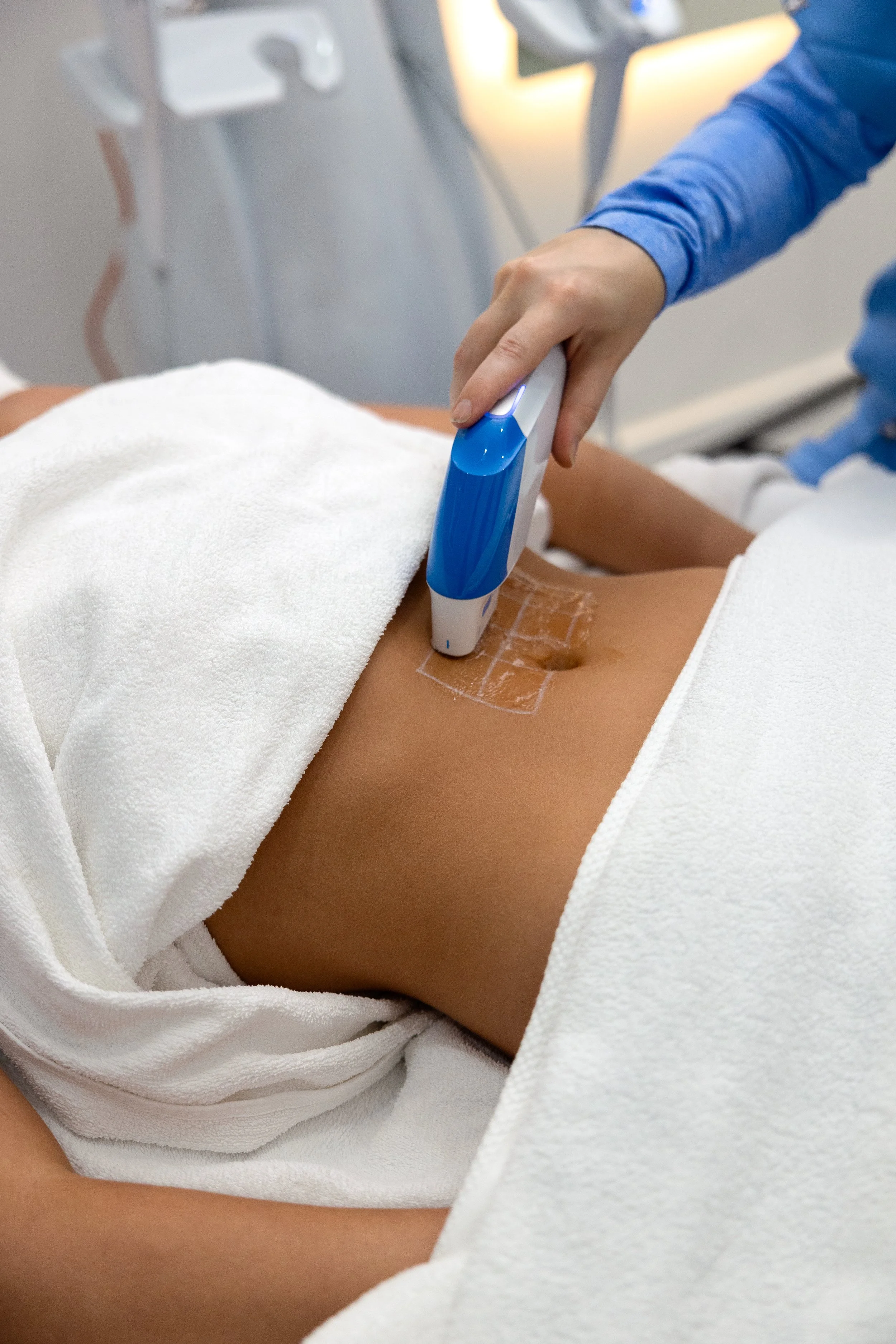 HIFU body treatment on the stomach at Shape of You North Perth