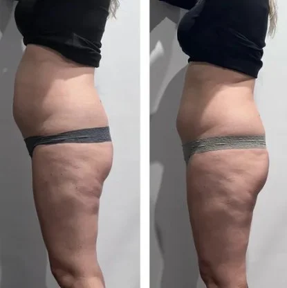 Body sculpting before and after at Shape of You