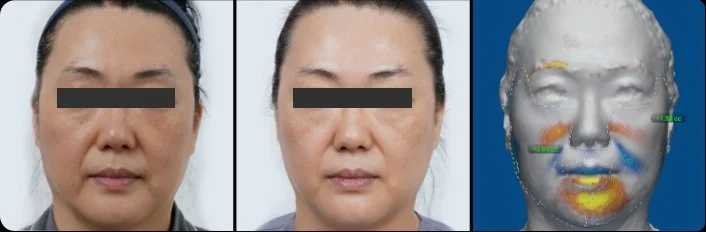 Ultraformer MPT HIFU full face lift before and after