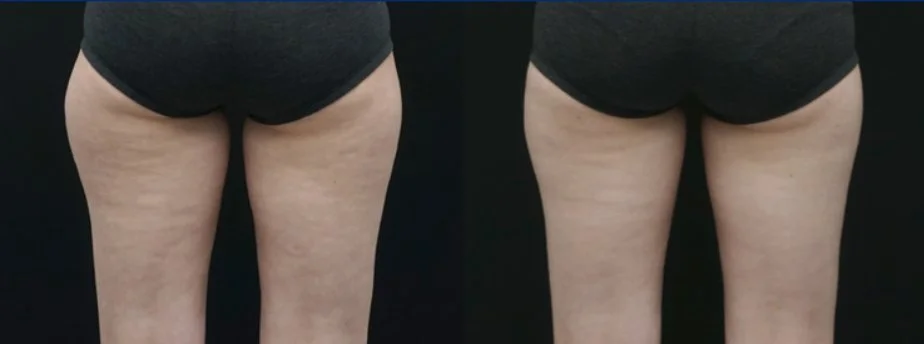 Thigh fat freezing before and after