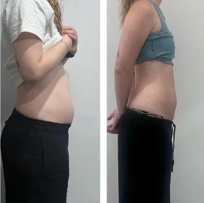 Body sculpting before and after at Shape of You