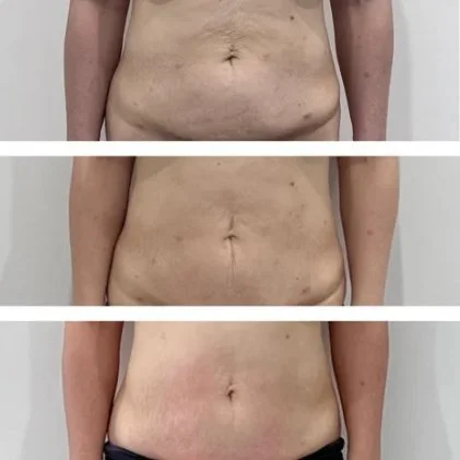 Body sculpting before and after at Shape of You