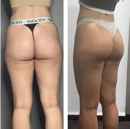 Body sculpting before and after at Shape of You