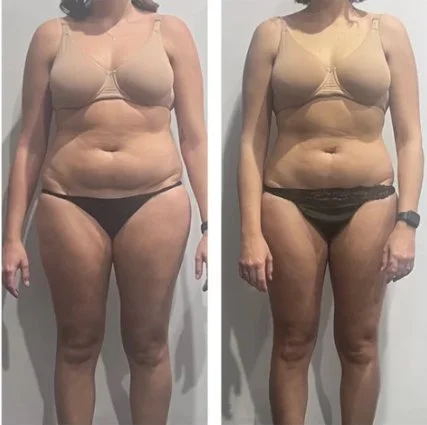 Body sculpting before and after at Shape of You