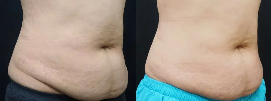Abdomen fat freezing before and after