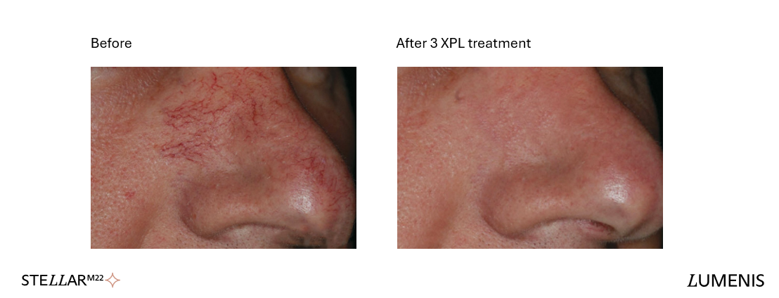 Lumenis Stellar M22 red veins and redness before and after