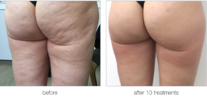 Venus DiamondPolar cellulite before and after