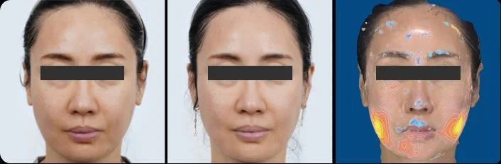 Ultraformer MPT HIFU jawline and lower face before and after