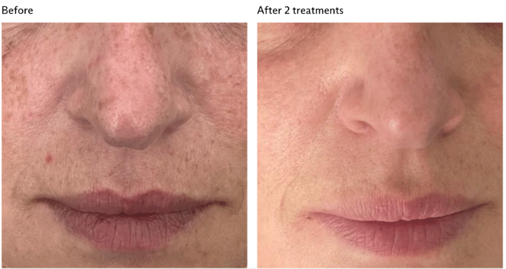 Skin renewal before and after at Shape of You