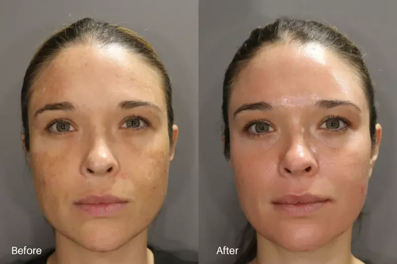 Melasma before and after treatment result