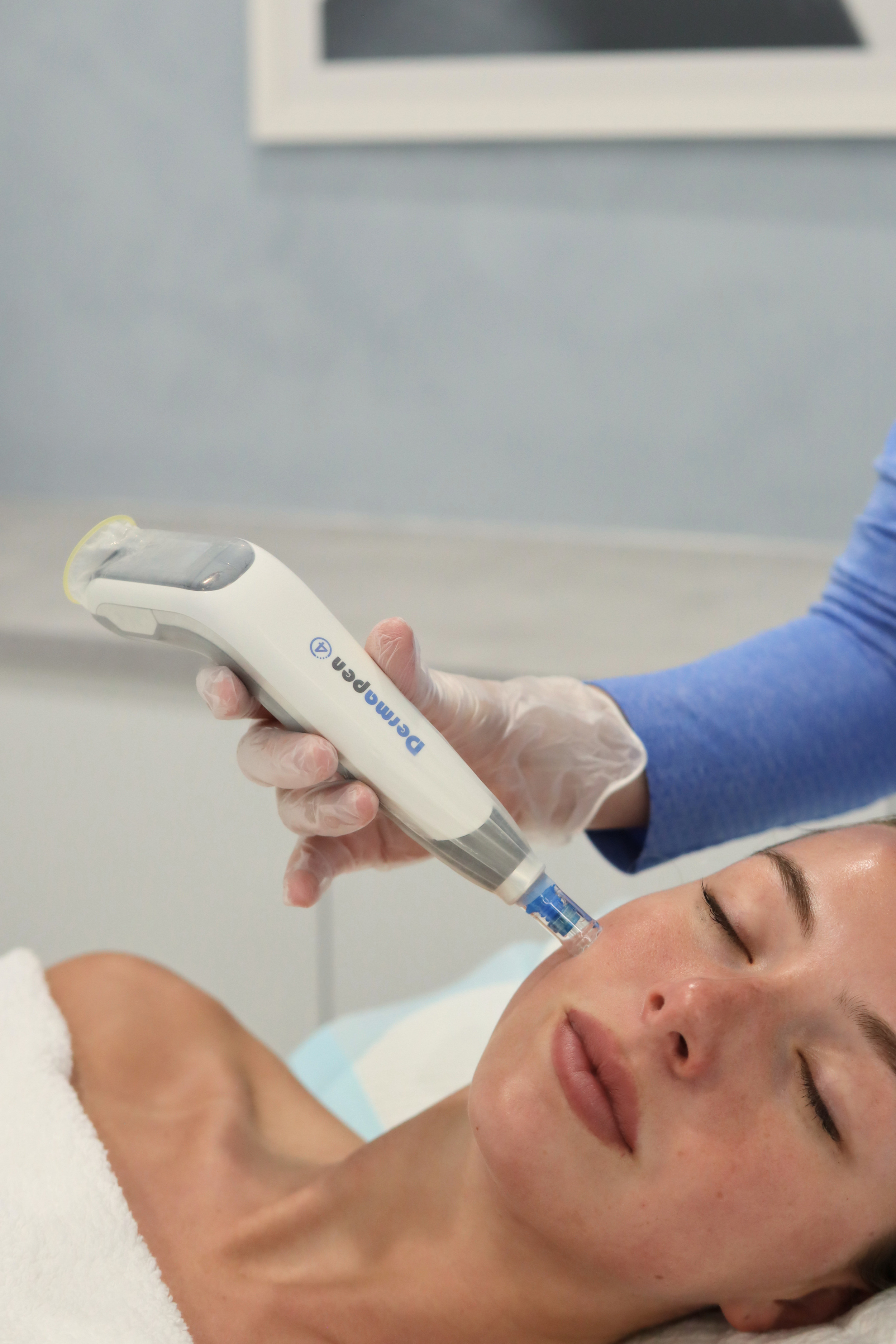 Dermapen 4 skin needling treatment at Shape of You North Perth
