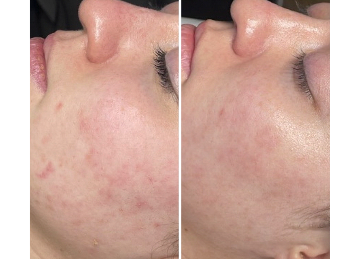 Microneedling before and after showing dramatic acne and redness reduction with smoother skin on cheek at A-Class Aesthetics in New Berlin WI