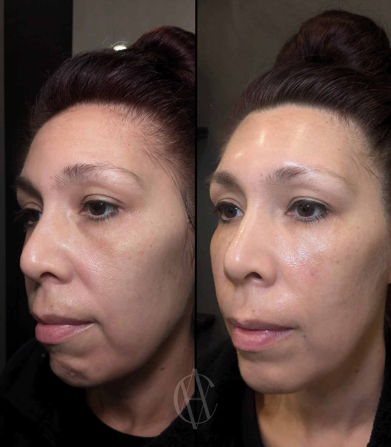 facial balancing before and after Sculptra cheek filler lower face neurotoxin oblique view New Berlin WI