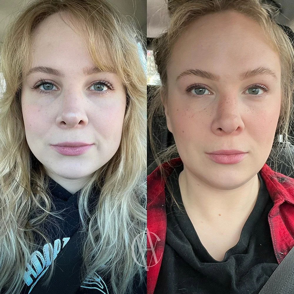 masseter botox TMJ jaw slimming before and after patient result New Berlin WI