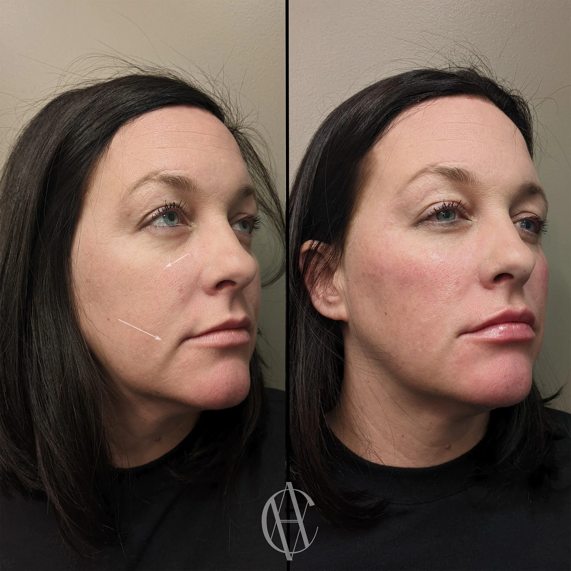 annotated before and after showing cheek filler lift and marionette line softening with labeled arrows at a med spa in new berlin wi
