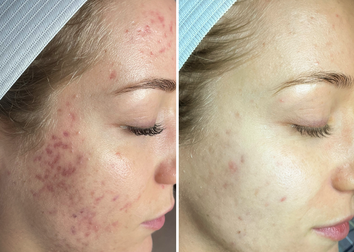 Microneedling before and after acne and redness reduction showing smoother skin on cheek at A-Class Aesthetics New Berlin WI