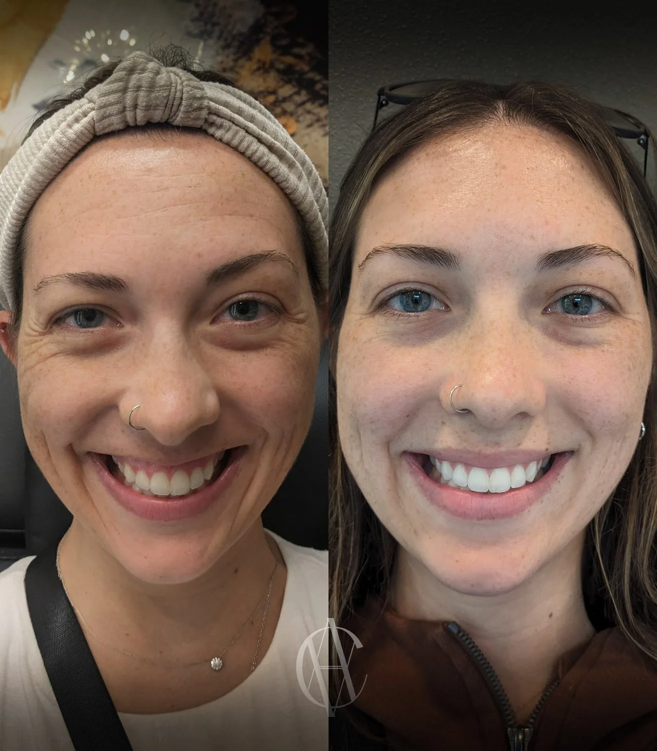 gummy smile lip flip combination before and after smiling front view New Berlin WI